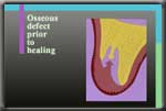 gum downgrowth into socket after extracton