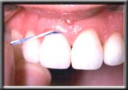 example image of flossing underneath gum