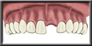 implant diagram 1