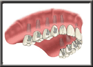 implant diagram 8