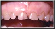 irregular gum levels with short chipped teeth