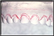 desired shape of tissue determined on model of patient's teeth