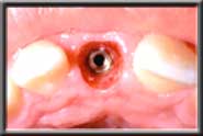 implant for missing front tooth