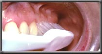 brushing upper molars example picture