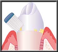 toothbrush angles under gum